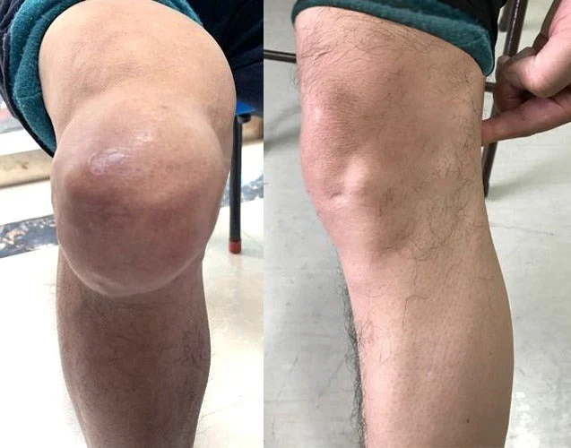 Avant / après FlexiSoin – genou